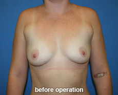 plastic-surgery-breast-augmentation